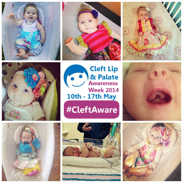 cleft palate awareness week